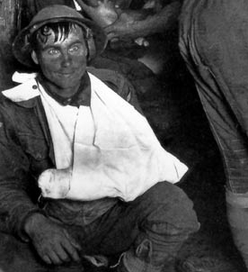 Ausschnitt aus einem Foto, das auf einem australischen Verbandsplatz in der Nähe von Ypern 1917 aufgenommen wurde. Der Soldat hat den Blick, der als „Two Thousand Yard Stare“ bezeichnet wird. <http://commons.wikimedia.org/wiki/File:Shellshock2.jpg?uselang=de>